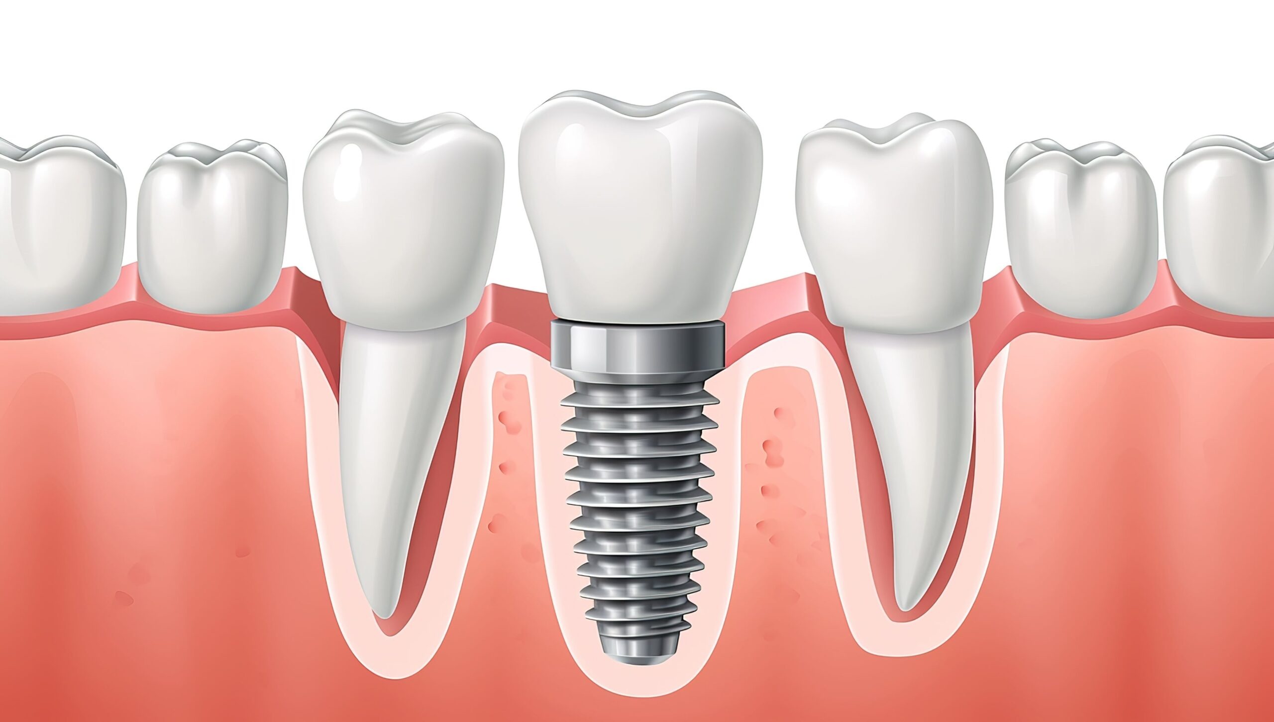 Implants