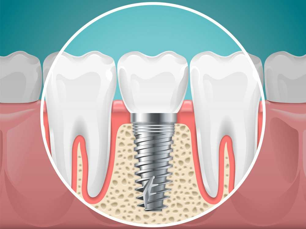 Are Same-Day Dental Implants Right for You? What Patients Should Know