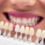 Porcelain Veneers in Agoura Hills: Treatment Steps and Aftercare Tips