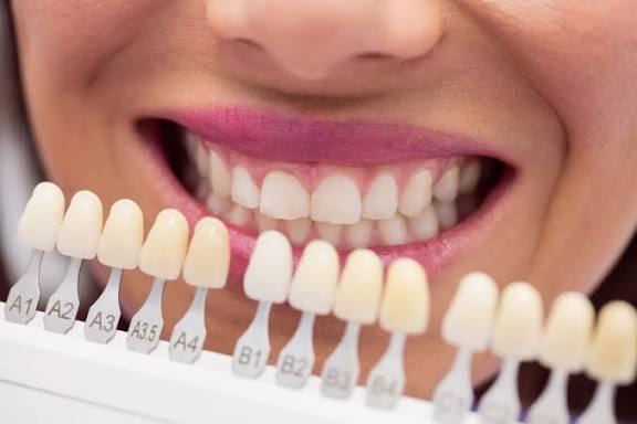 porcelain veneers Agoura Hills